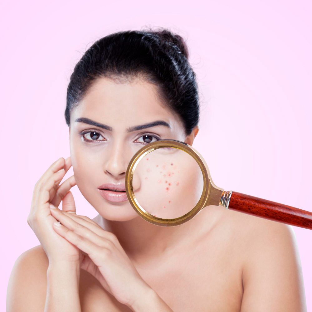 Acne Treatment in KPHB