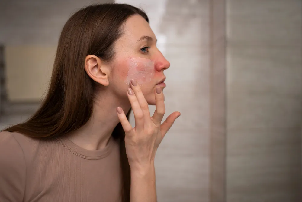 Understanding Rosacea at Derma 360 Clinics
