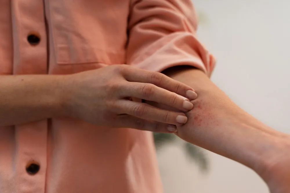 Managing Eczema and Dry Skin at Derma 360