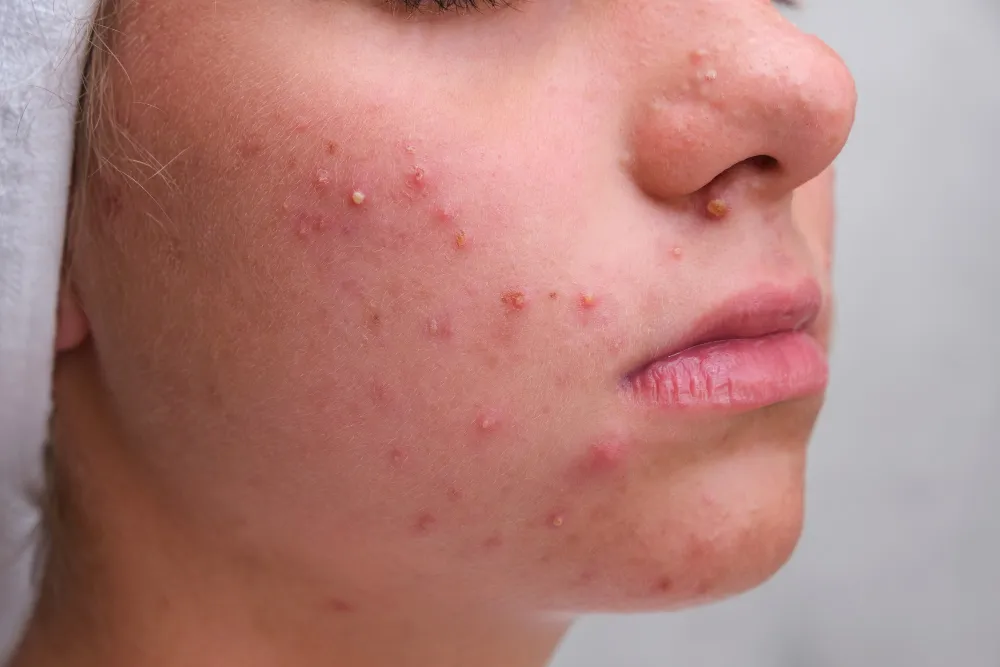 Acne Scar Treatment KPHB - Advanced Solutions