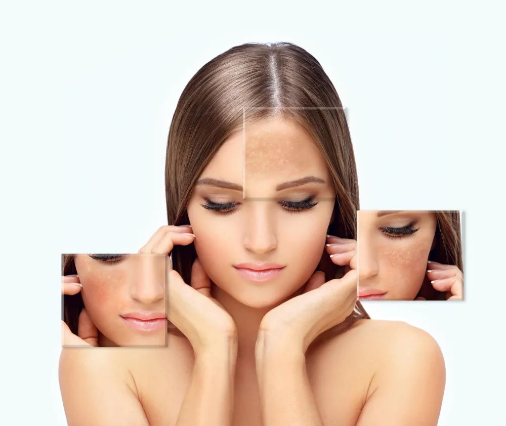 Melasma Treatment in Kukatpally
