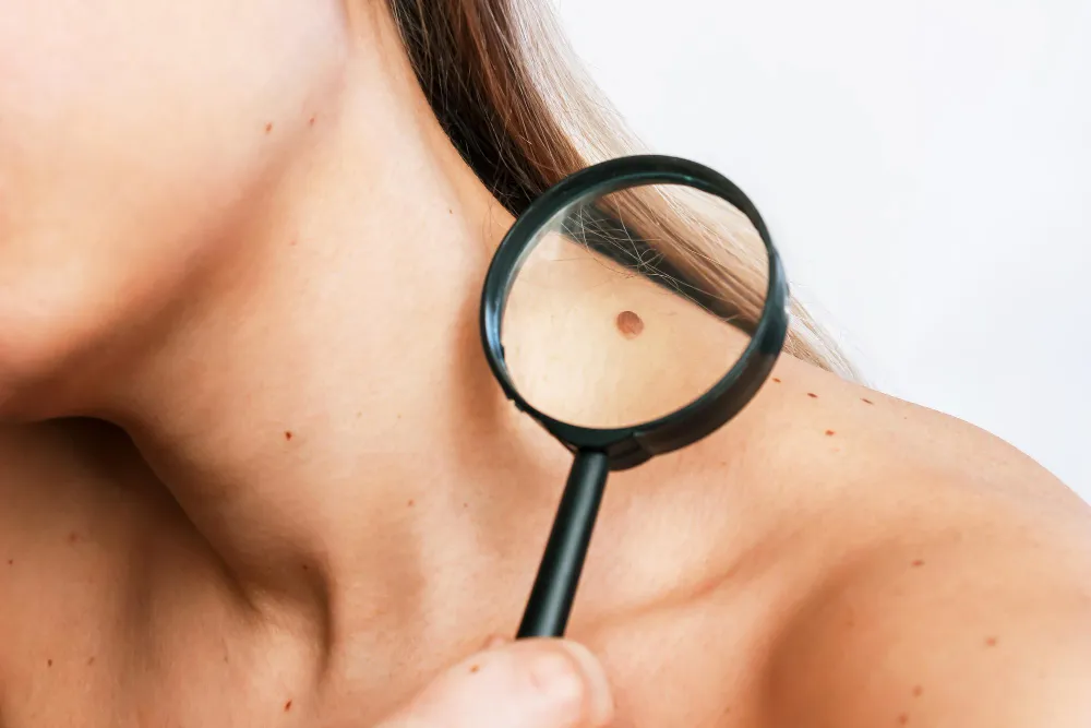 Mole Removal KPHB - Safe Procedures