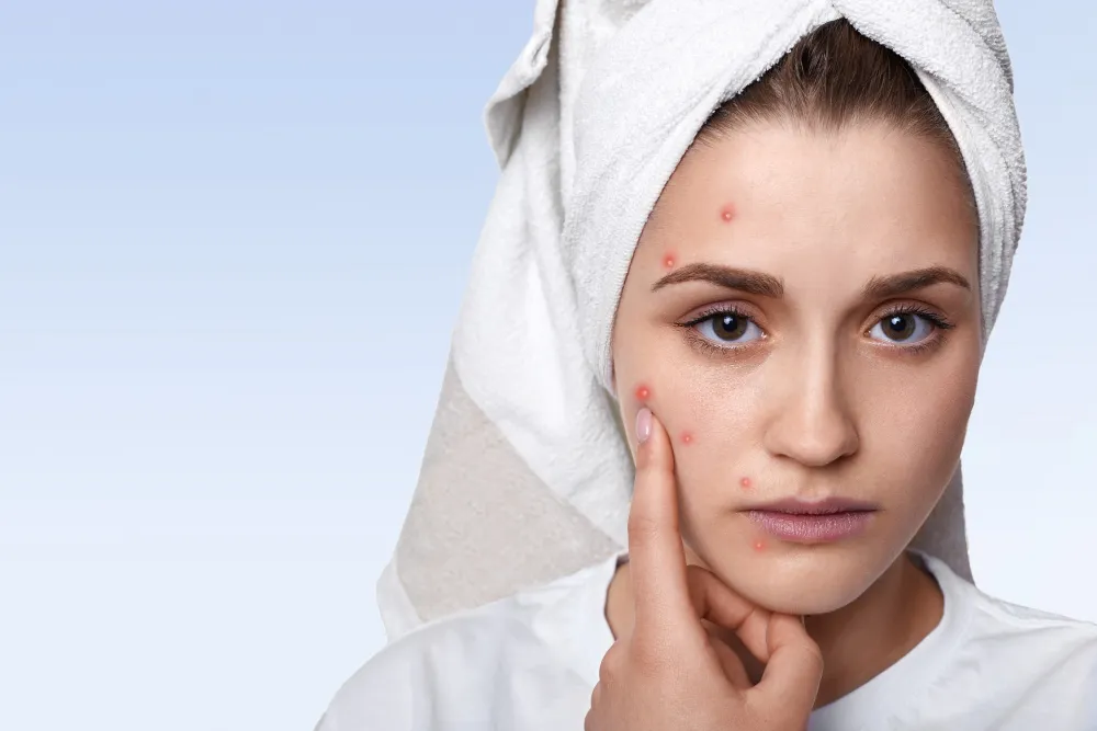 You Don’t Have to Suffer with Acne
