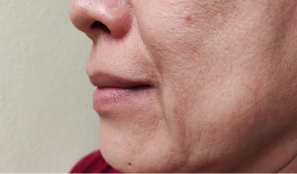 Smile Lines Treatment